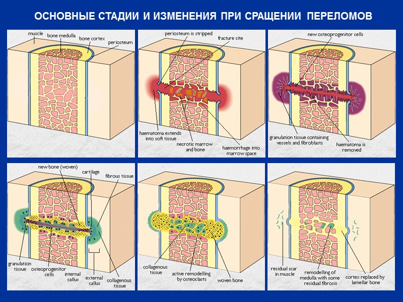 ОСНОВНЫЕ СТАДИИ И ИЗМЕНЕНИЯ ПРИ СРАЩЕНИИ ПЕРЕЛОМОВ